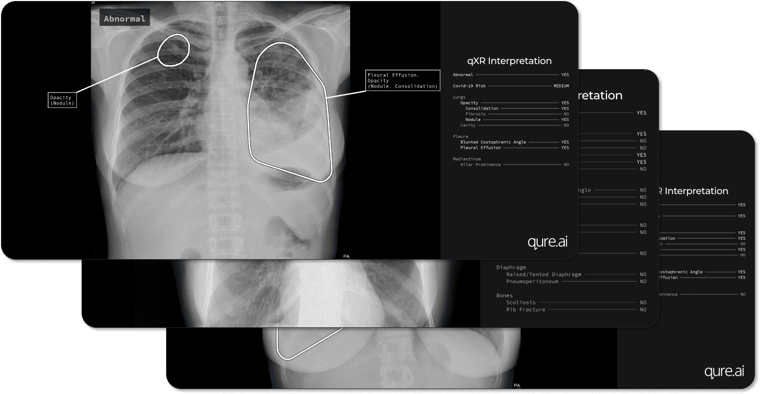 AI-assisted chest X-rays