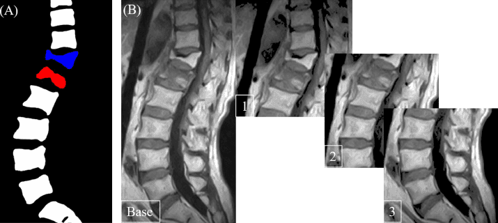 Spotting vertebral fractures
