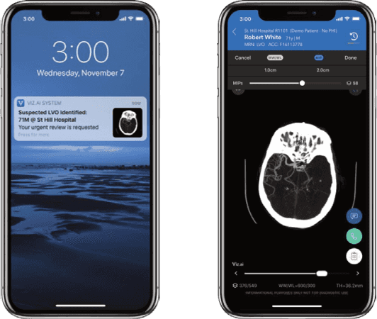 The Viz LVO device offers automatic stroke detection and notification (left), coupled with a mobile DICOM viewer (right)