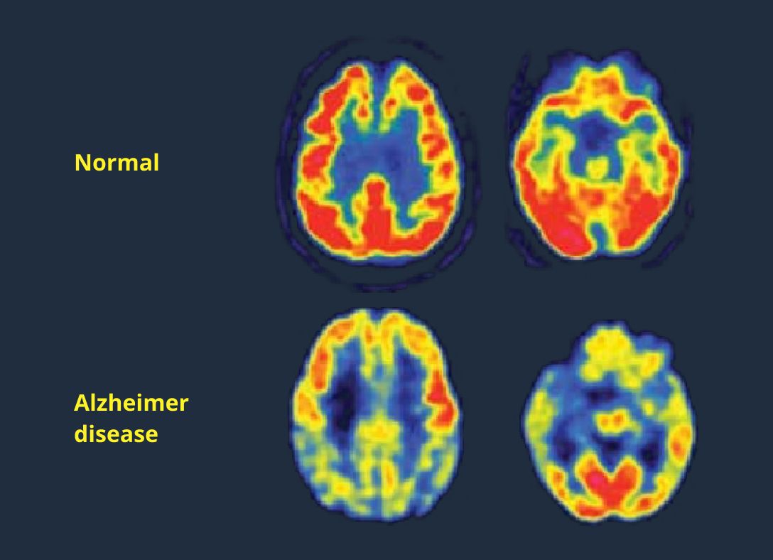 Detecting Alzheimer’s disease